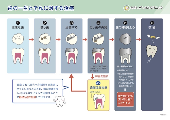 歯髄保存療法の重要性とMTAセメントについて