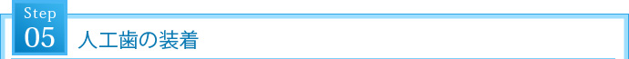STEP5. 人工歯の装着